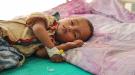 لمواجهة سوء التغذية في اليمن .. اليونيسف تتلقى تمويلا  بمبلغ 30 مليون دولار 